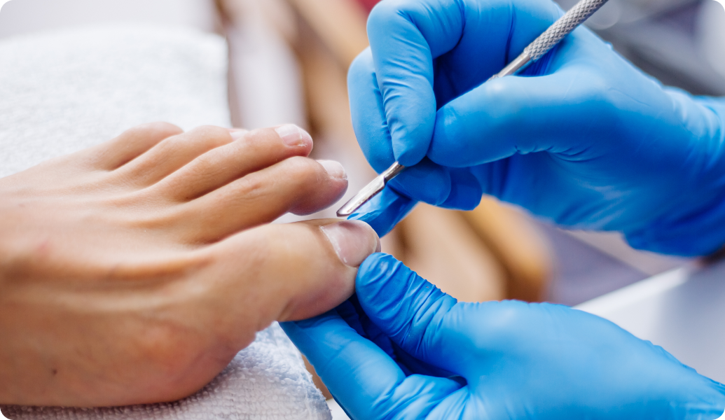 Nail Fold Infection (Paronychia)