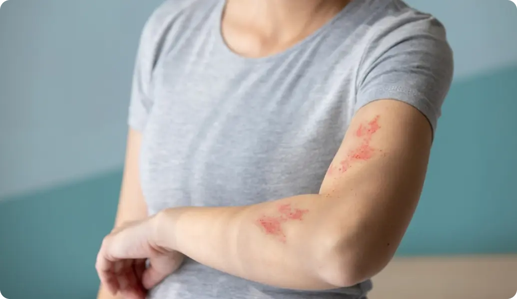 Shingles (Herpes Zoster)